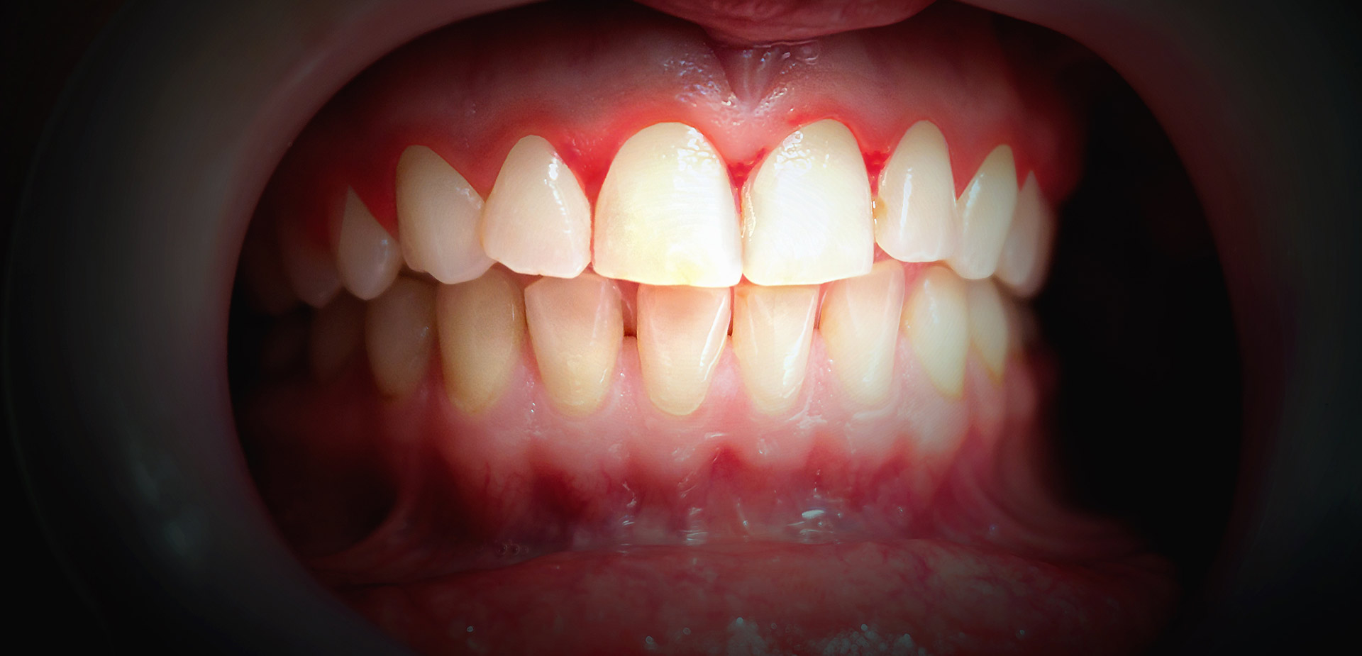How to avoid gum disease