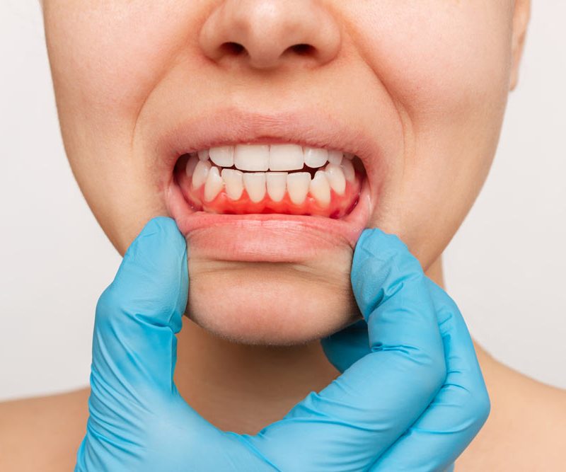 dental exam gum disease