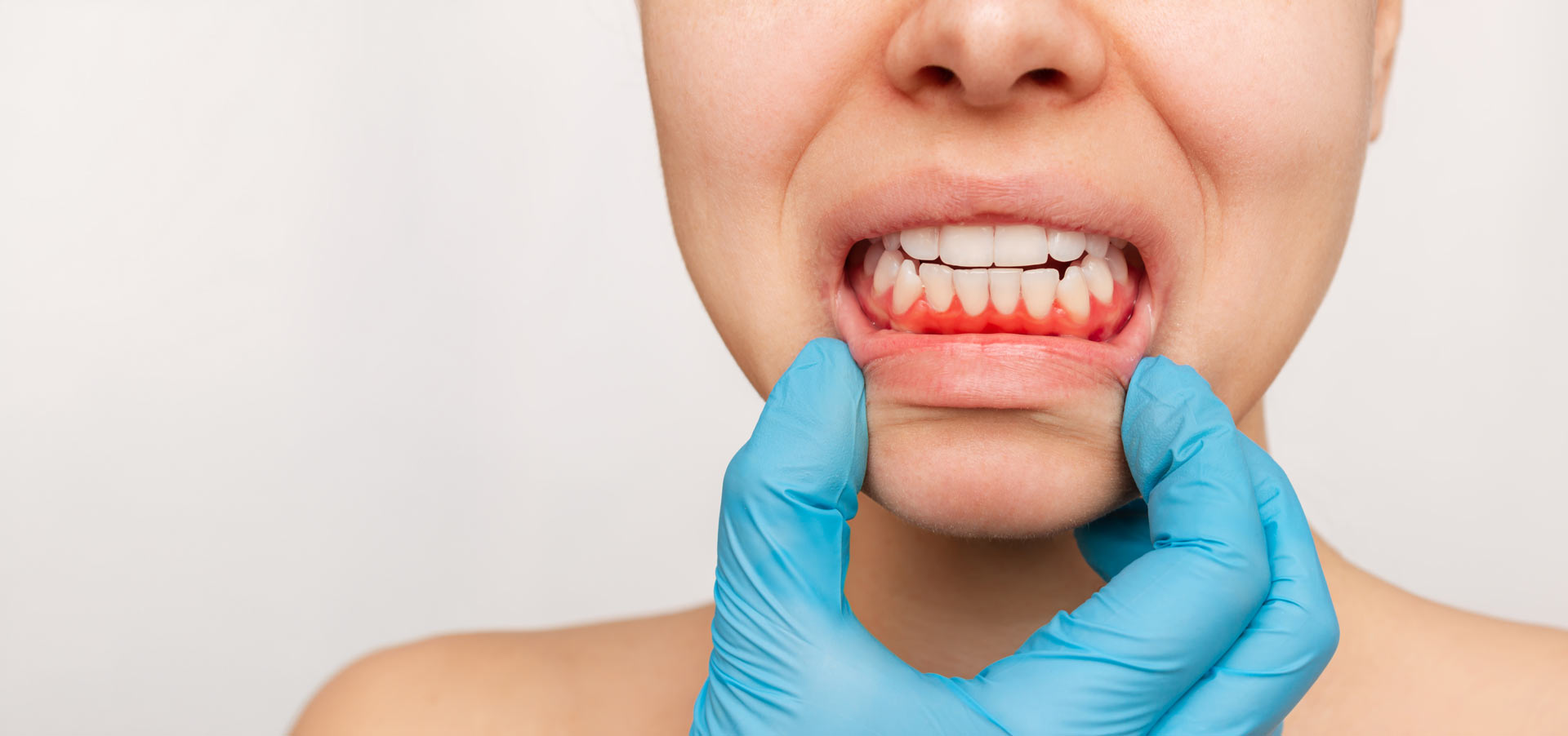 Gum disease: what actually is it and how can it be avoided?